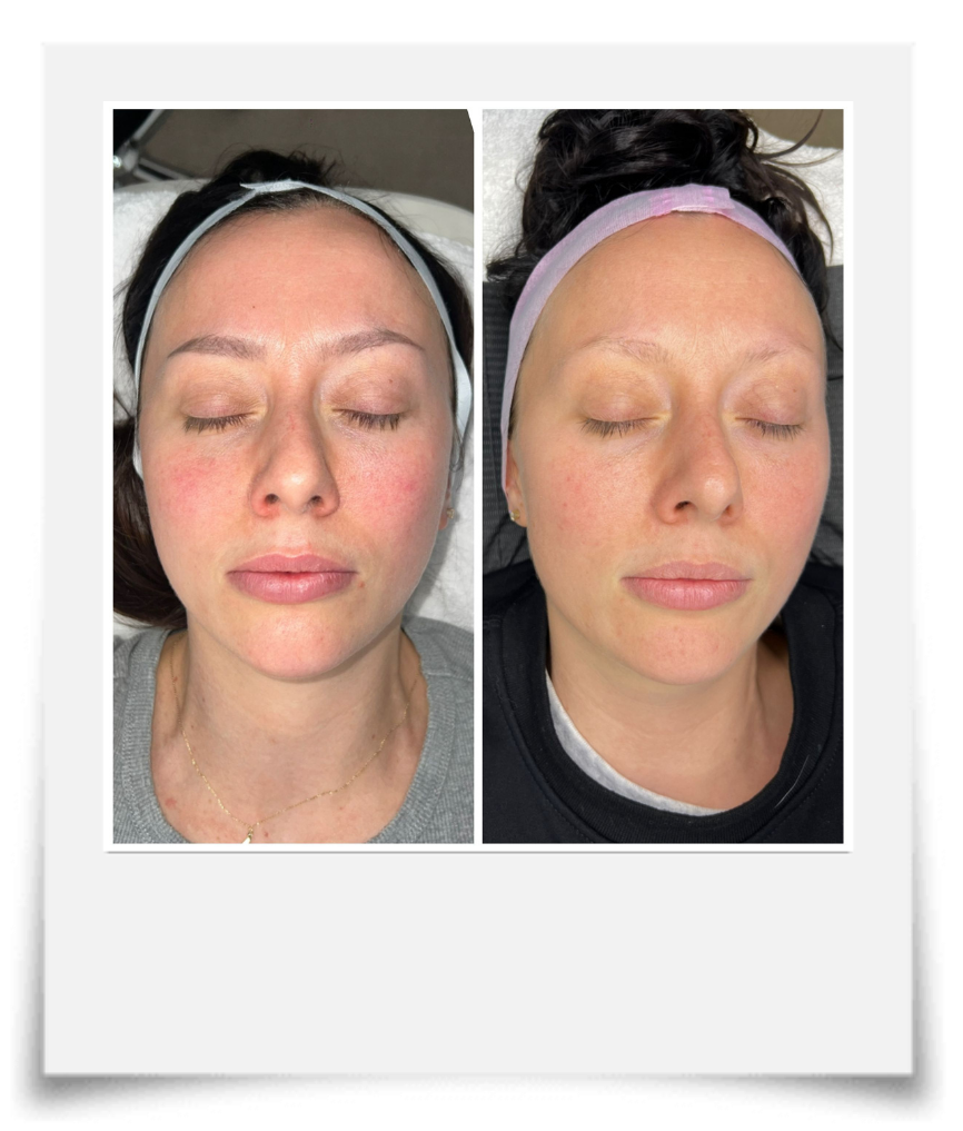 Side-by-side comparison of a woman before and after a skincare treatment, both with eyes closed, showing improvements in skin redness and texture.