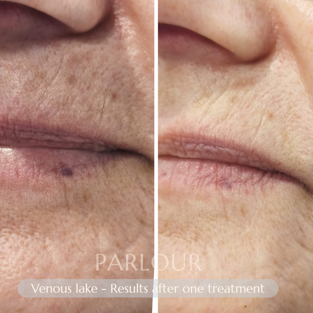 Venous Lake Laser Treatment