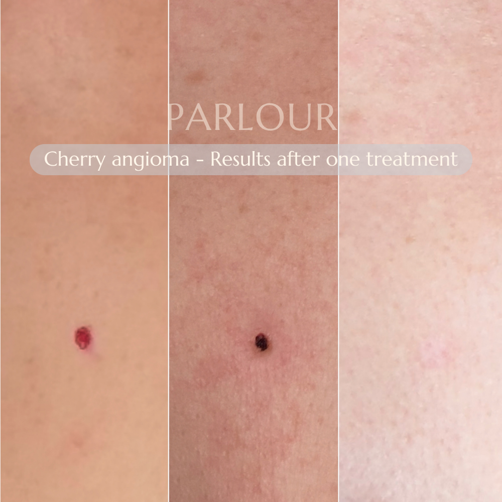 Cherry Angioma Treatment