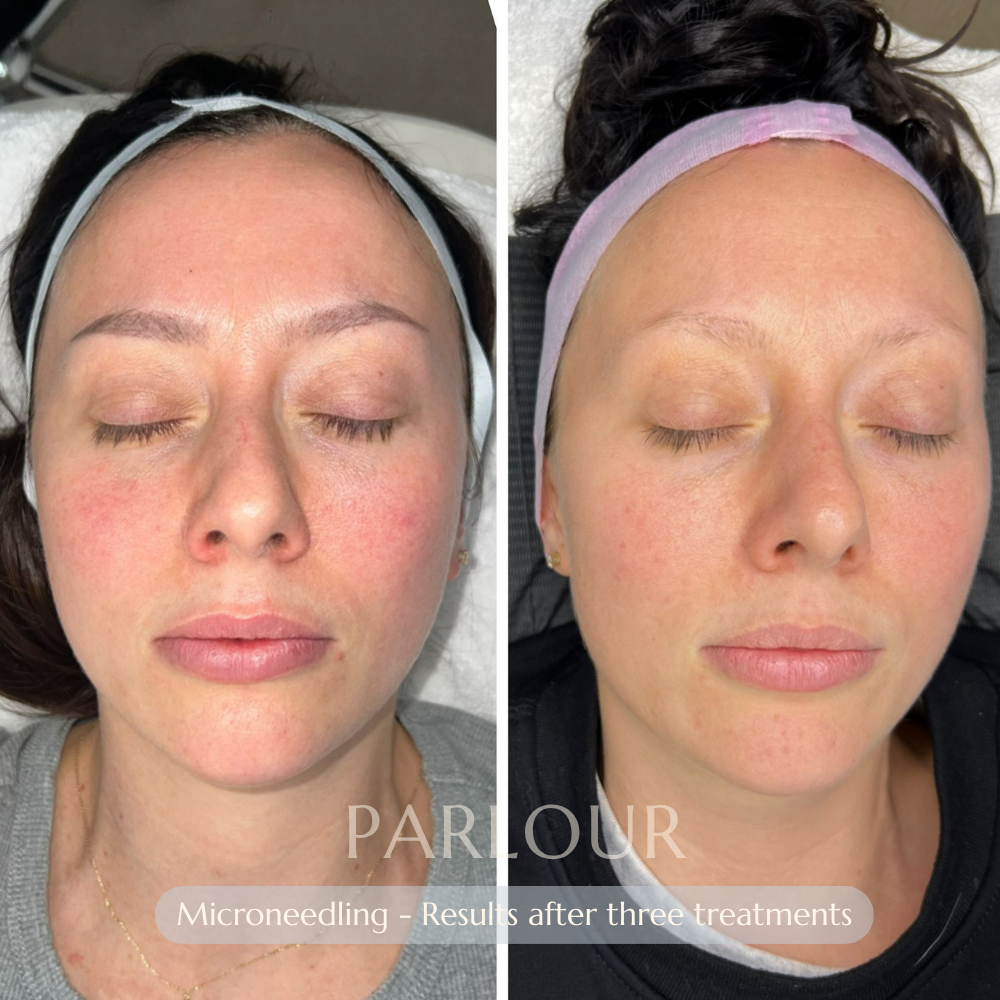 Microneedling Treatment