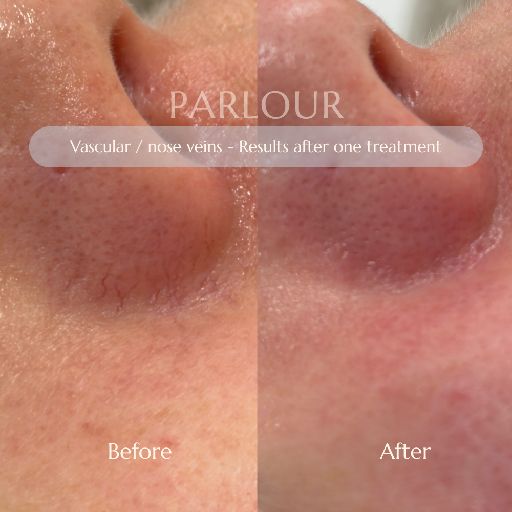 Facial Veins Treatment