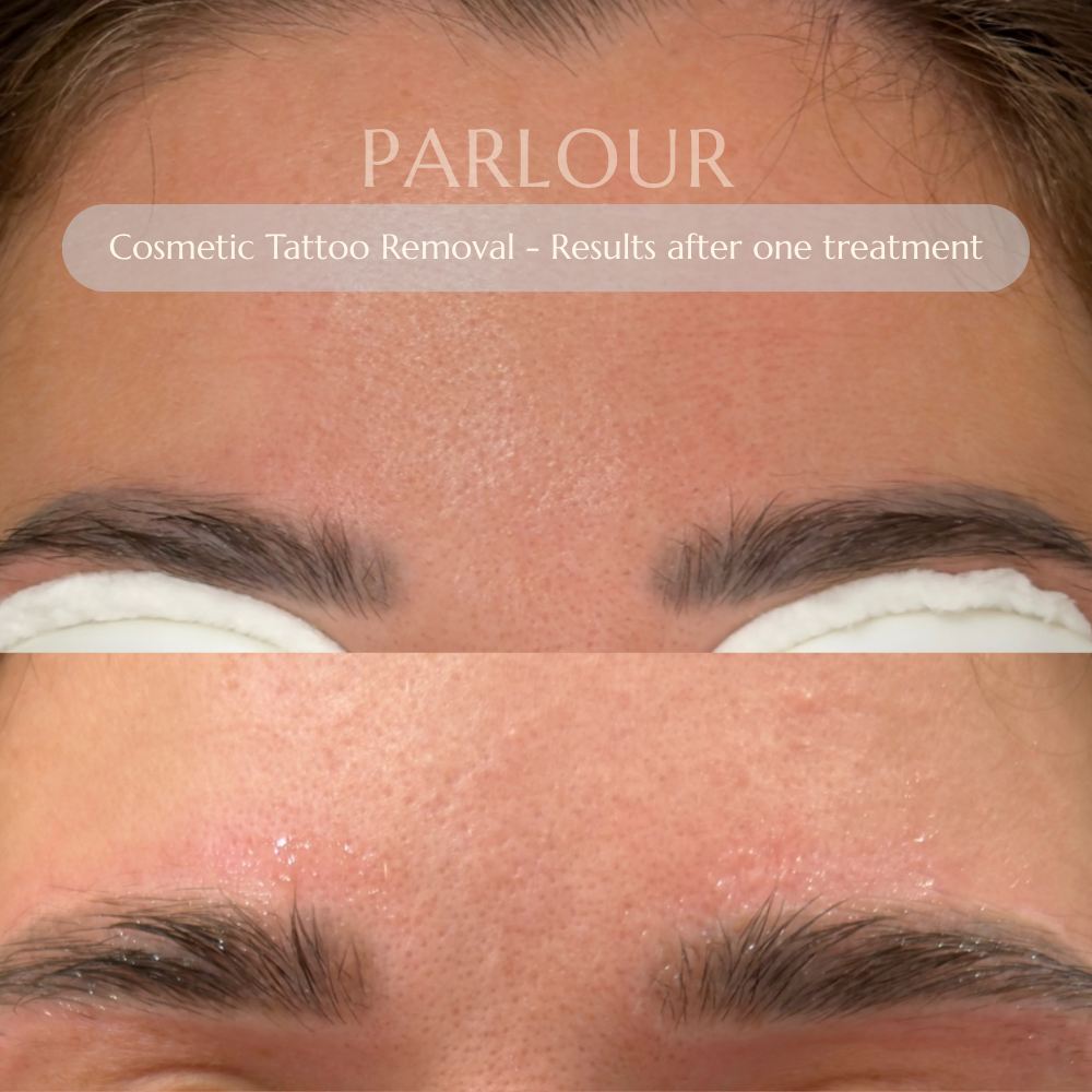 Cosmetic Tattoo Removal
