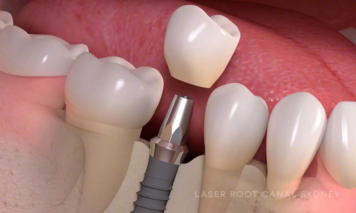 © Laser Root Canal Sydney Dental Implant.jpg