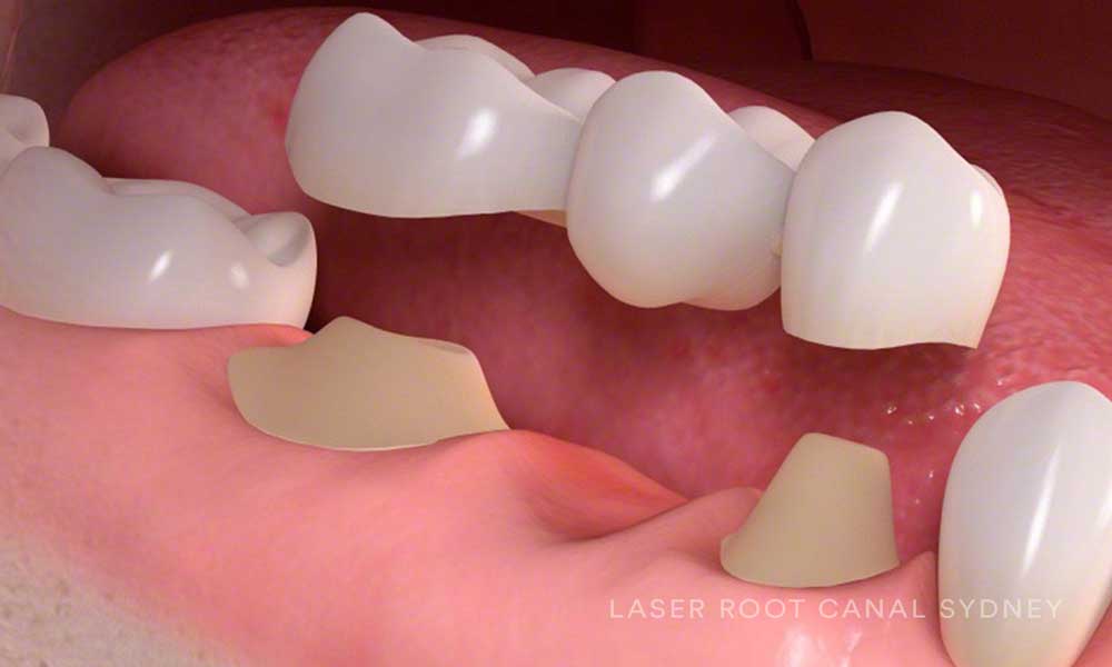 © Laser Root Canal Sydney Dental Bridge.jpg