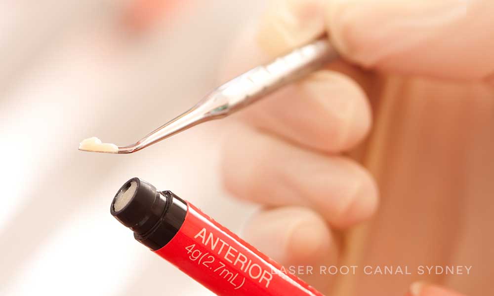 © Laser Root Canal Sydney Temporary Fillings Dental Composit Bonding.jpg