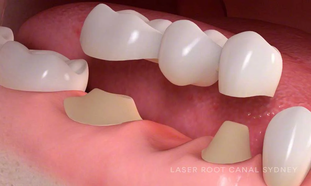 © Laser Root Canal Sydney Dental Bridge.jpg