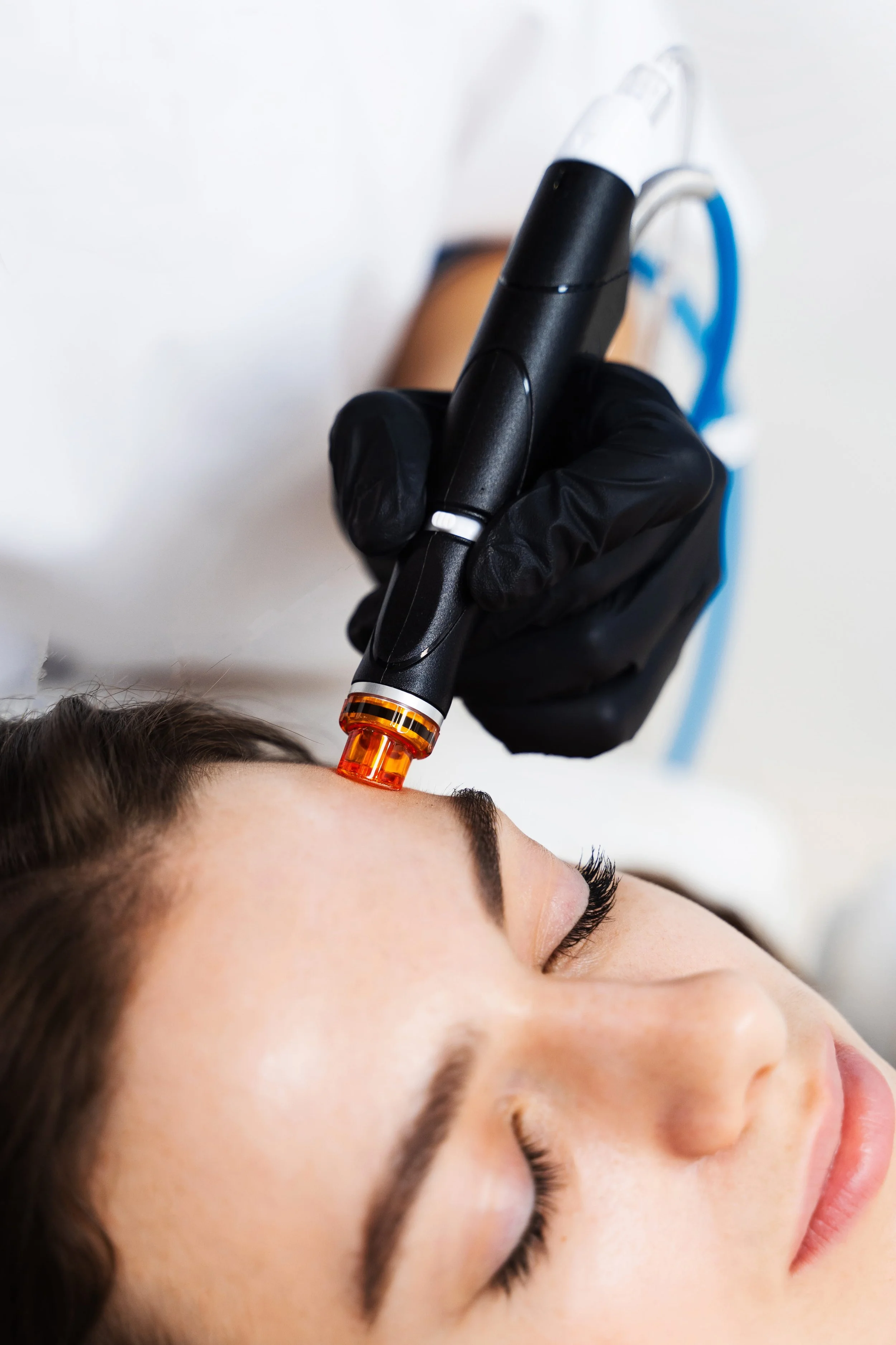 A person receiving a cosmetic or medical treatment to the forehead using a device held by a gloved hand.