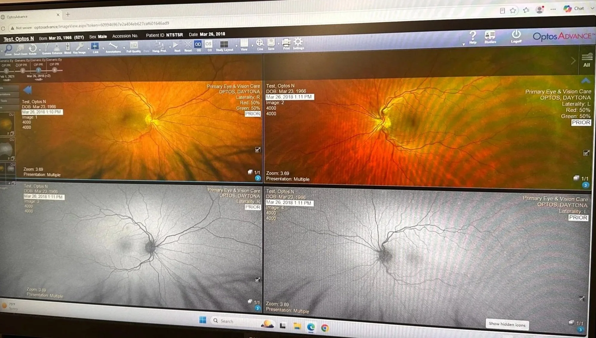 A screenshot of an eye examination display showing visual analysis images of both eyes, with detailed data and annotations.
