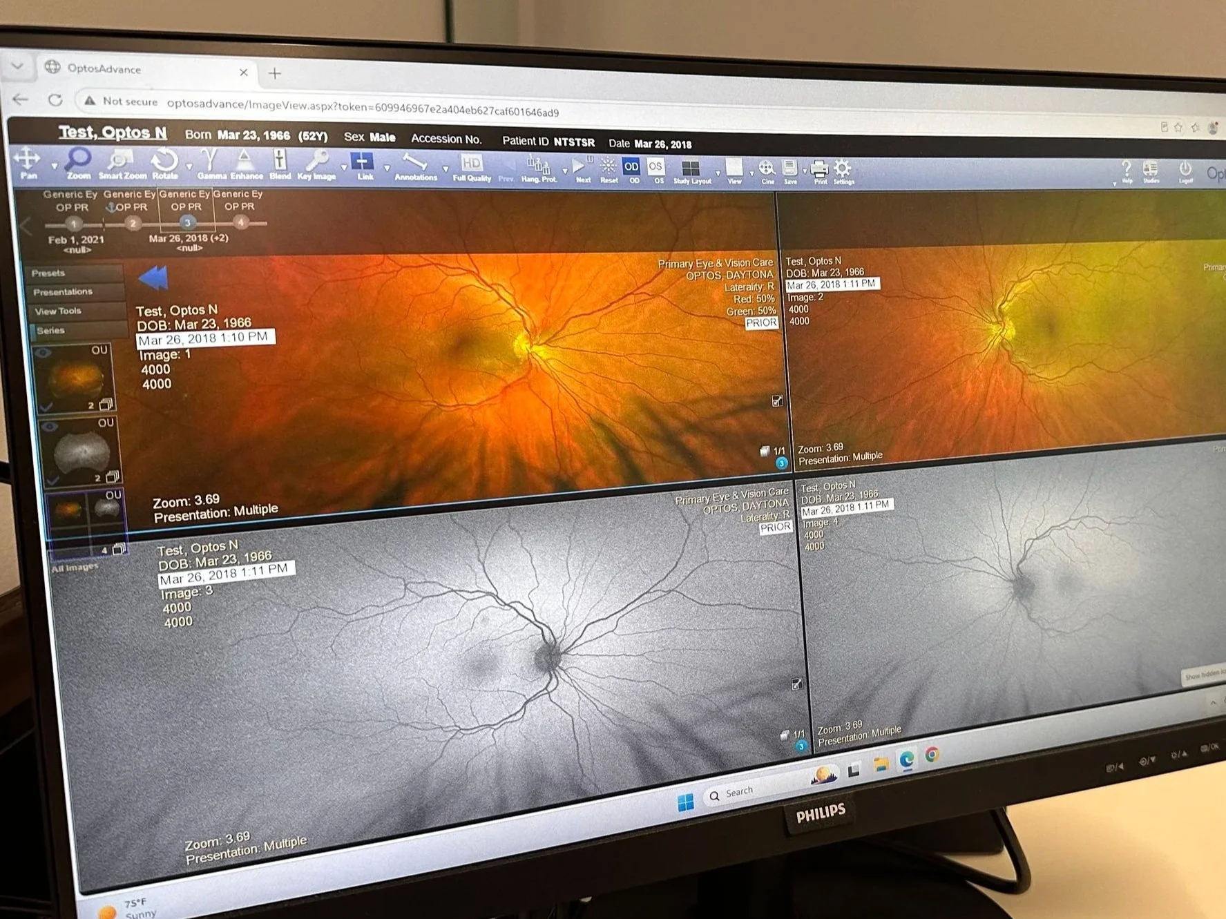 A computer monitor displaying four retinal images with annotations and patient information for eye examination