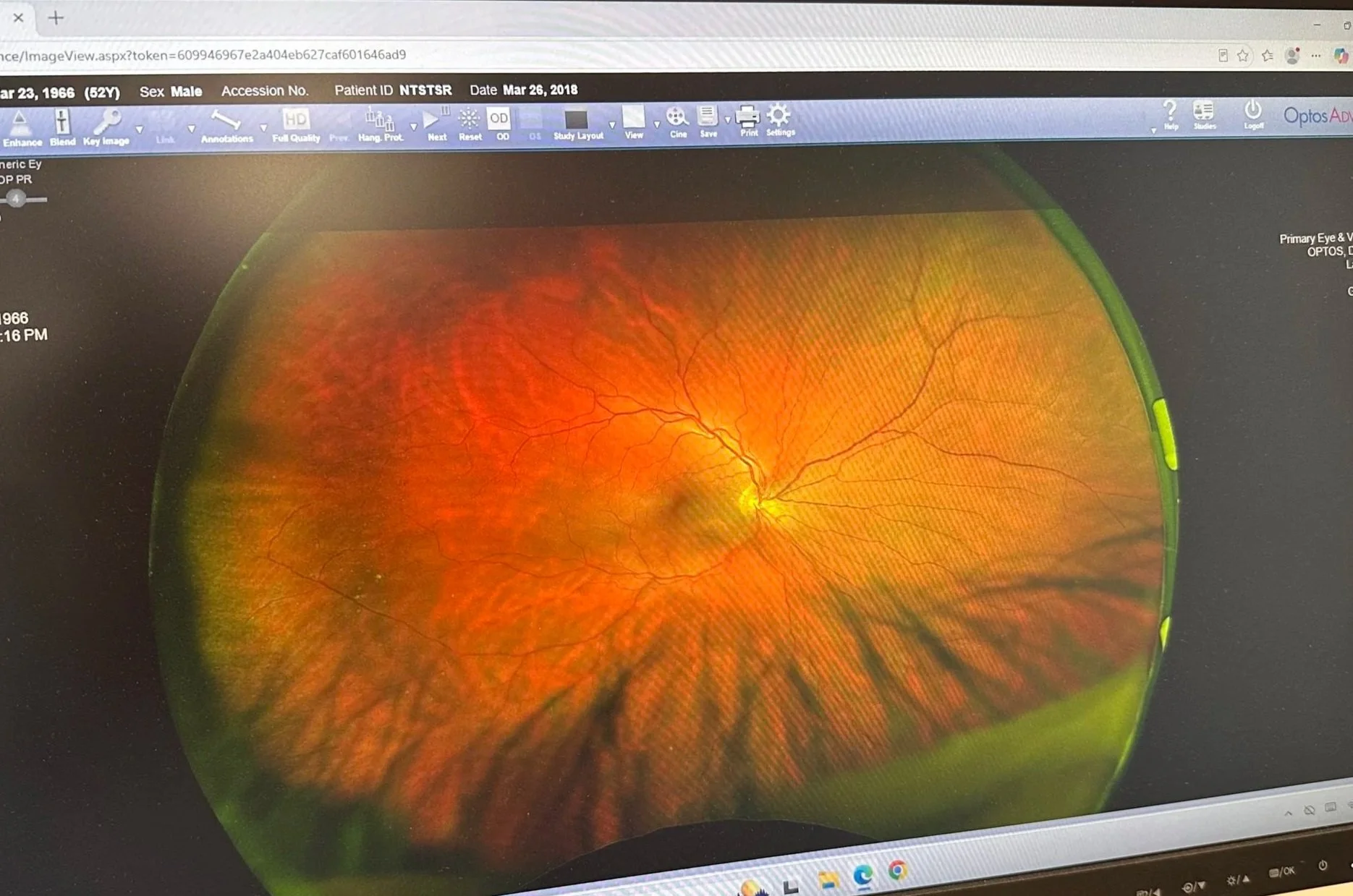 Digital scan of a human retina showing blood vessels, optic disc, and macula with medical annotations and interface on a computer screen.