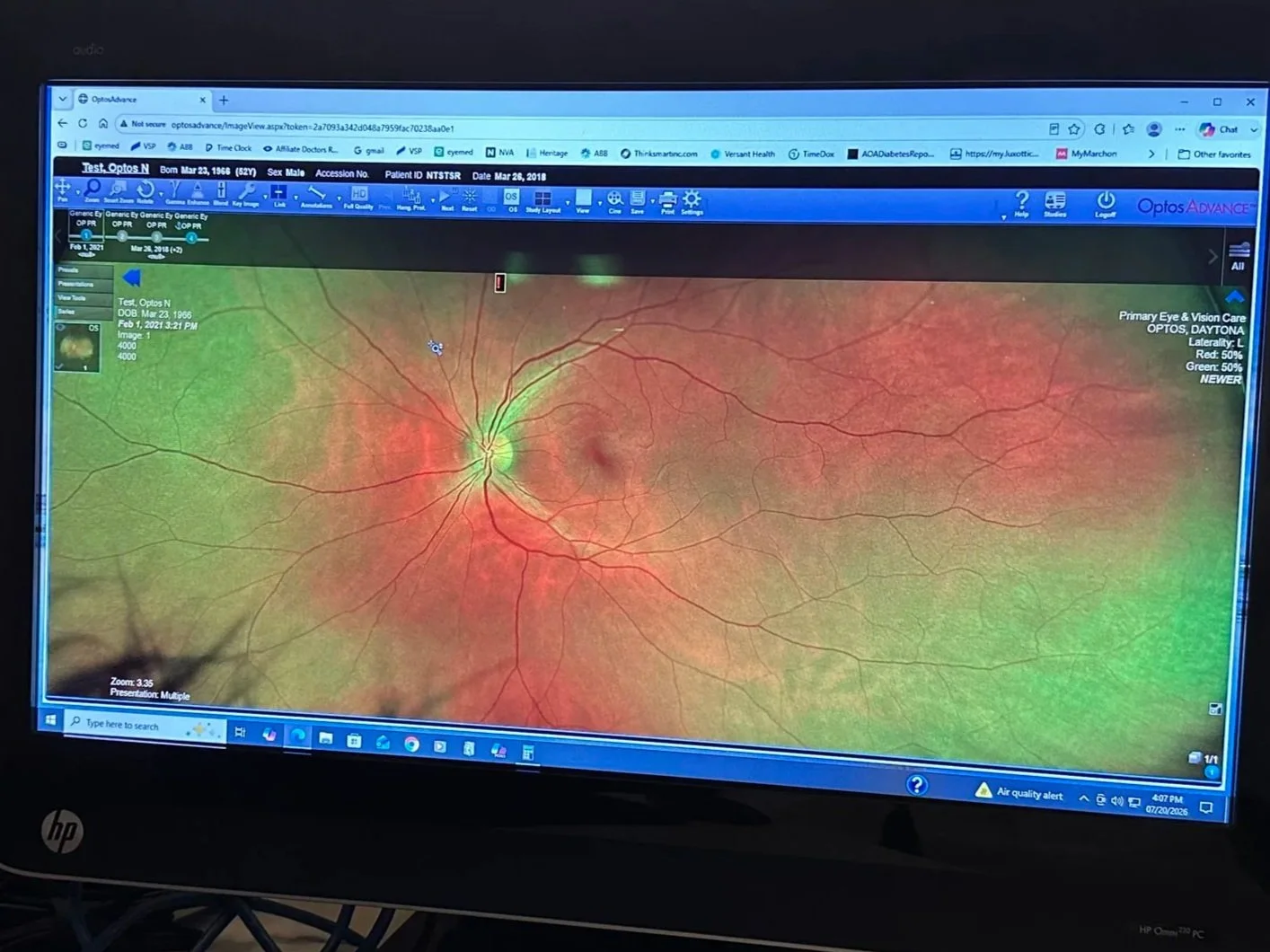 Digital retinal scan showing detailed view of a human eye's retina with optic nerve and blood vessels, displayed on an ophthalmology software screen.
