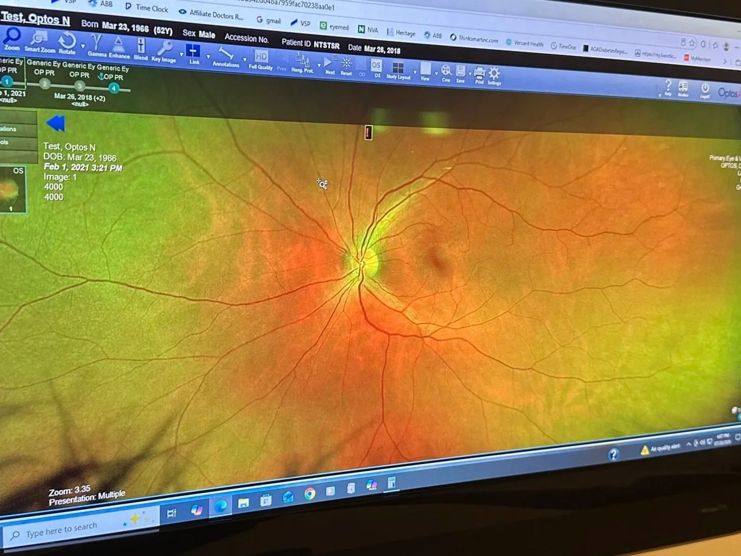 Retinal scan displaying optic disc, blood vessels, and macula on a computer screen in an eye examination.