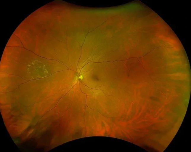 Color fundus photo of the human retina showing blood vessels and optic disc.
