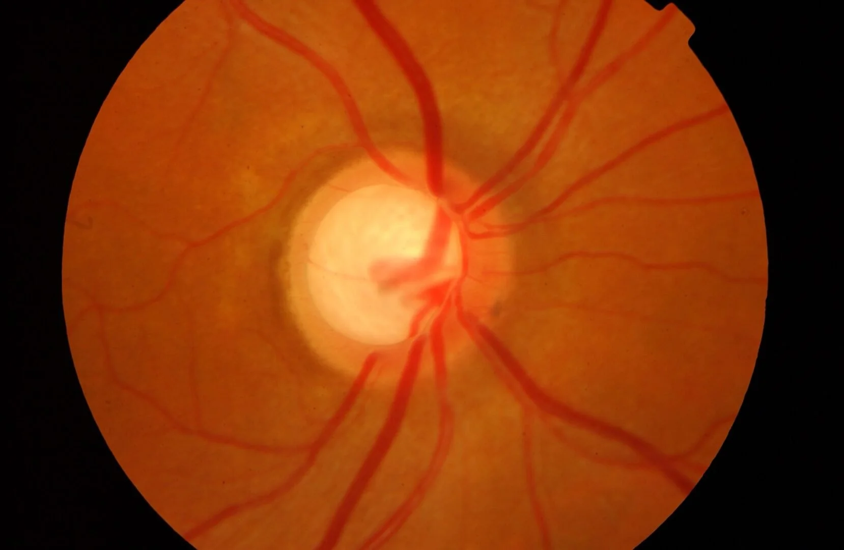 Close-up view of the human retina showing blood vessels, optic disc, and macula.