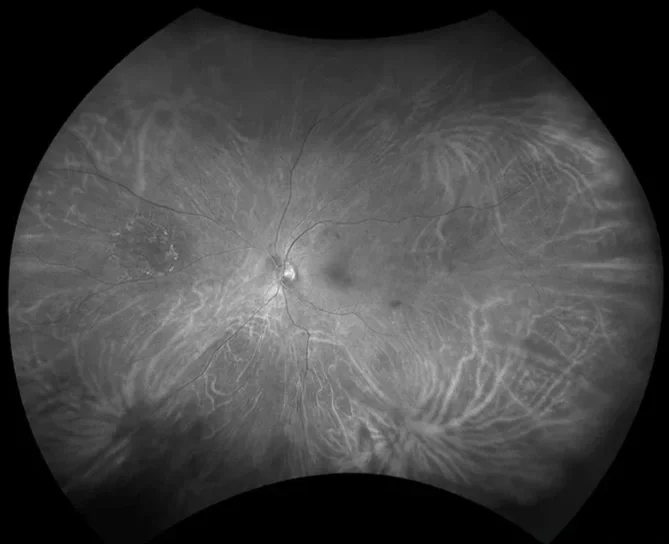 A grayscale fundus photograph of the human eye showing the optic disc, blood vessels, and retinal features.