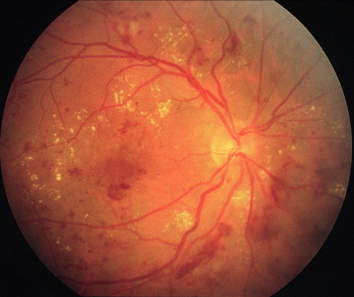 Retinal scan showing the optic nerve head, blood vessels, and retinal tissue with some yellowish deposits.