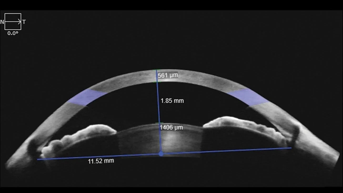 Scanning electron microscope image of a human cornea with measurements showing corneal thickness of 1.85 millimeters, central thickness 1406 micrometers, and arc length 561 micrometers.
