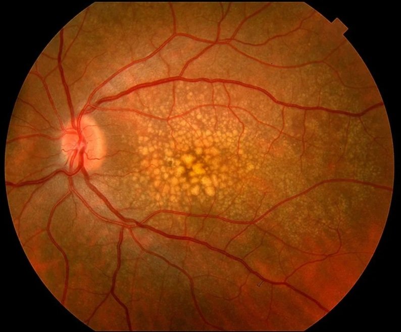 Close-up of the human retina showing the optic nerve head, blood vessels, and yellowish deposits in the central area.