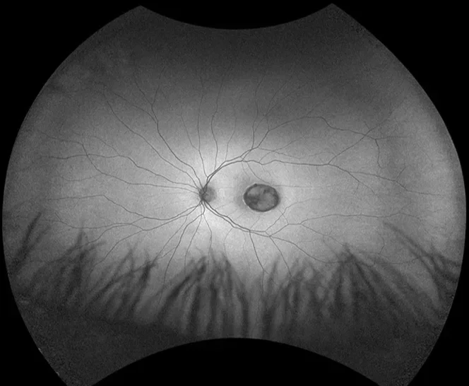 Black and white image of an eye's retina showing the optic disc, blood vessels, and a central lesion or tumor.