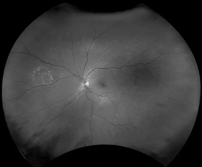 Black and white retinal scan showing the optic disc and blood vessels with some abnormalities in the left area.
