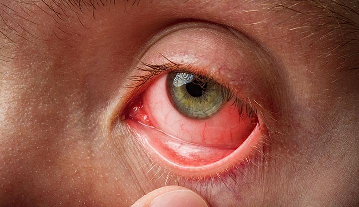 Close-up of a red, irritated human eye being pulled open by a finger, showing blood vessels and redness.