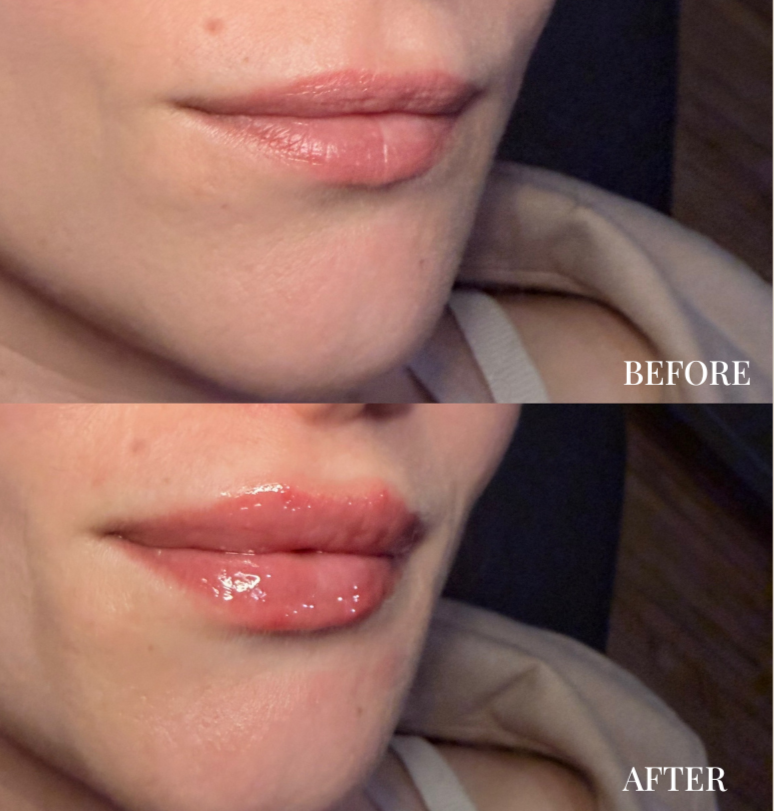 Lip filler results in Mineral Point Wisconsin