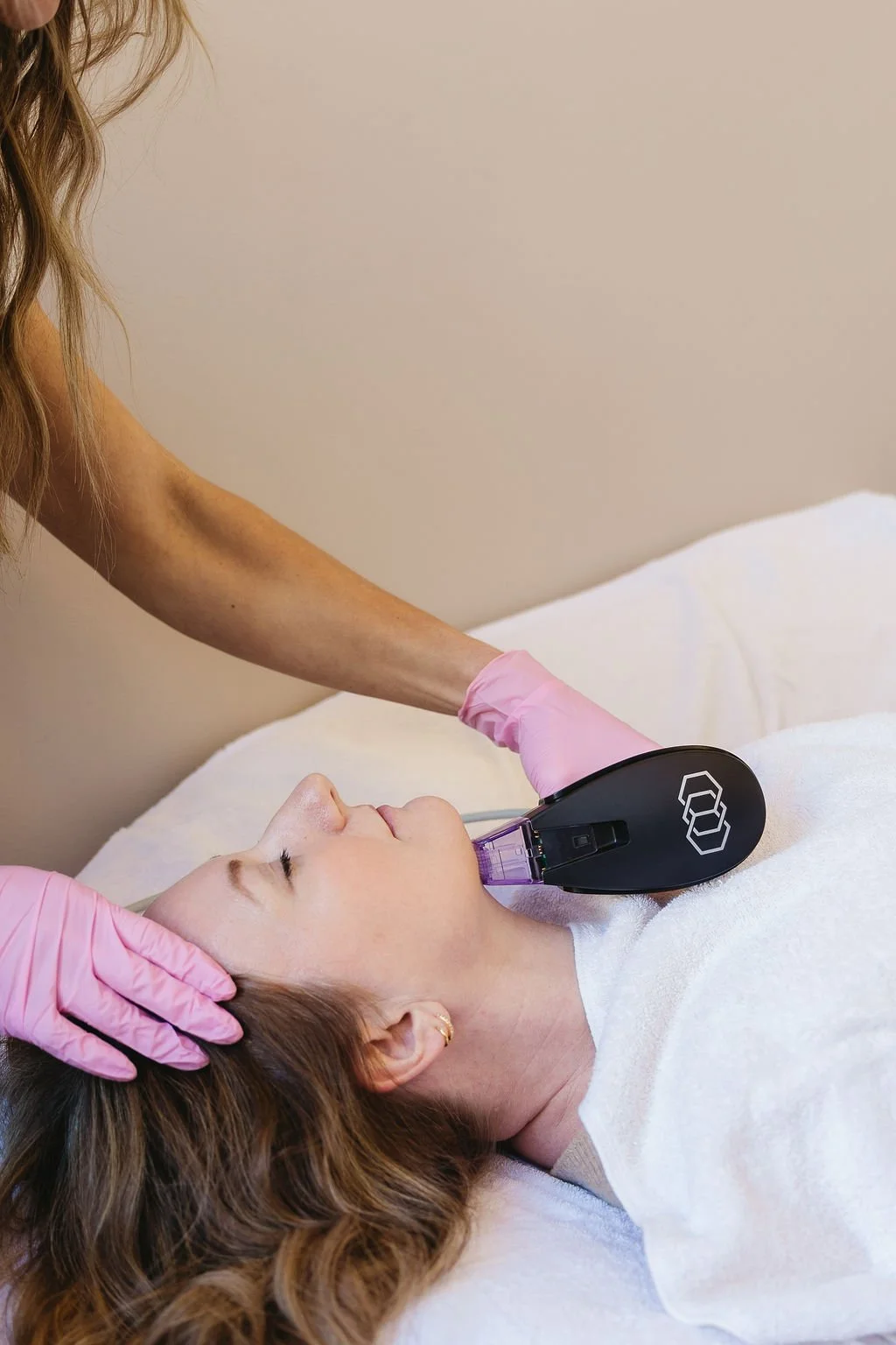 IPL treatment for pigmentation correction