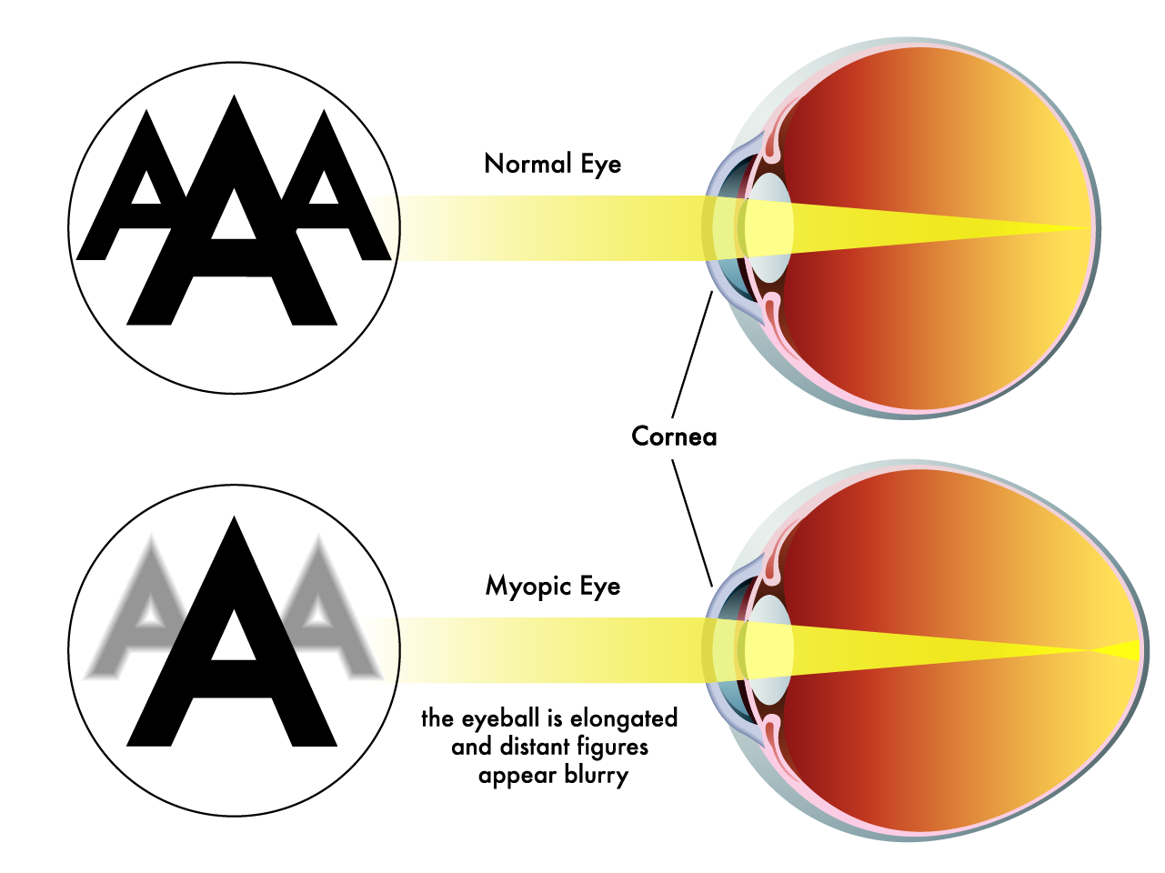 Diagram comparing normal eye focusing and eye with a vision correction lens, showing light rays entering the eye and focusing on the retina.