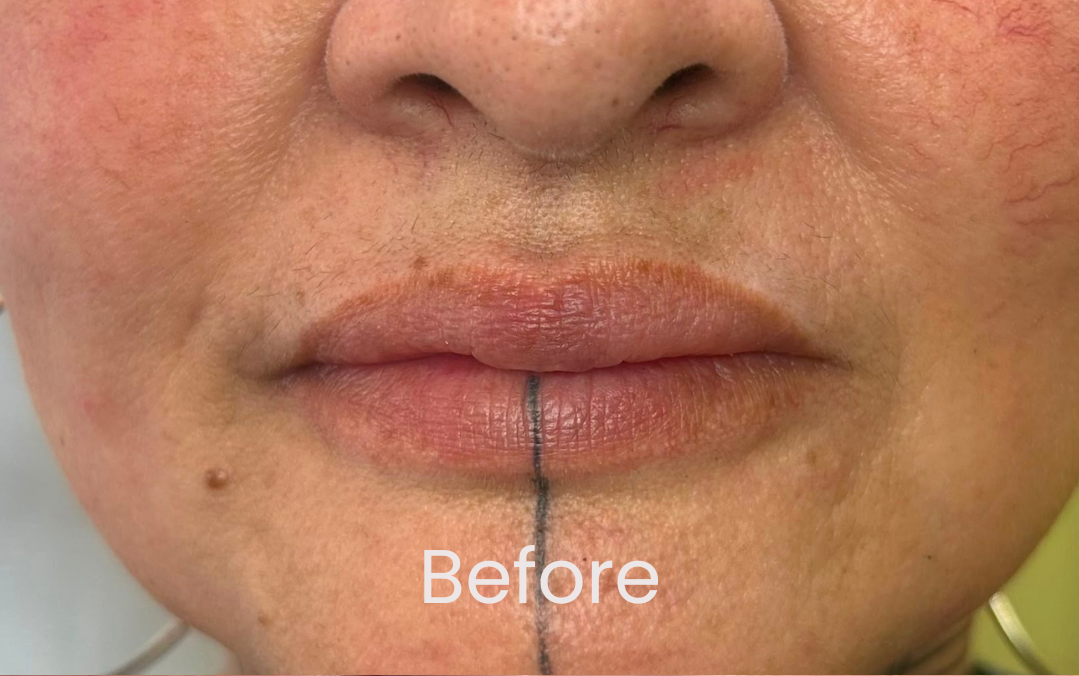 Close-up of a client's lips before undergoing her PMU lip treatment.