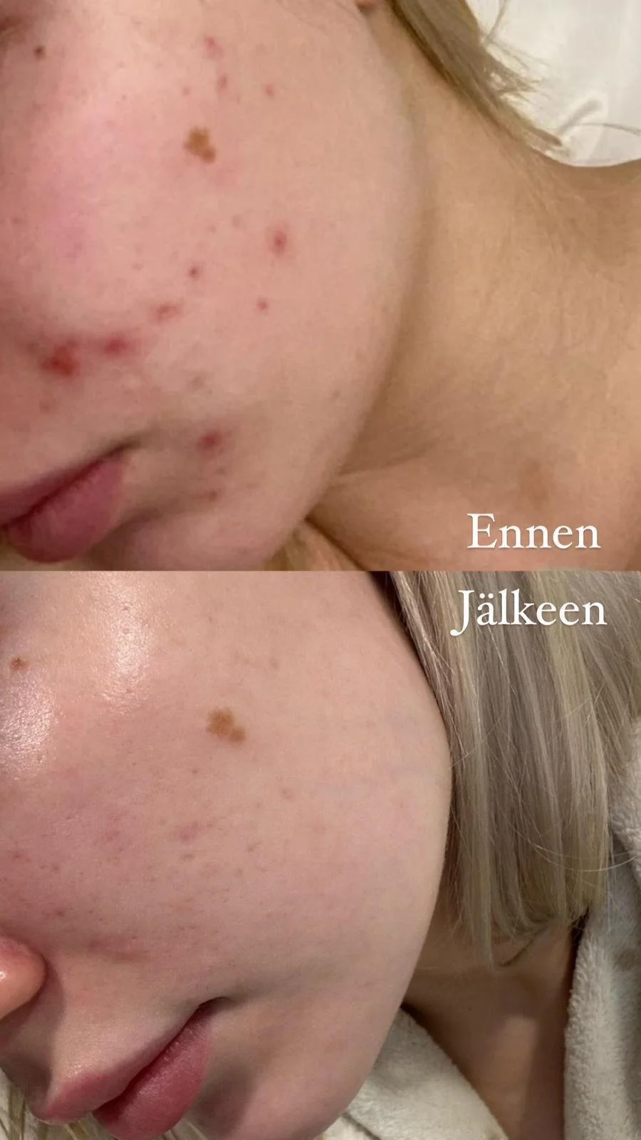 Ensimmäinen kuva (Ennen) näyttää akneahdistuneen henkilön kasvojen epätasaisuutta ja aknearpiä. Toinen kuva (Jälkeen) näyttää selkeämmältä ja paremmin hoidetulta iholta, jossa on vähemmän aknea ja epätasaisuutta.