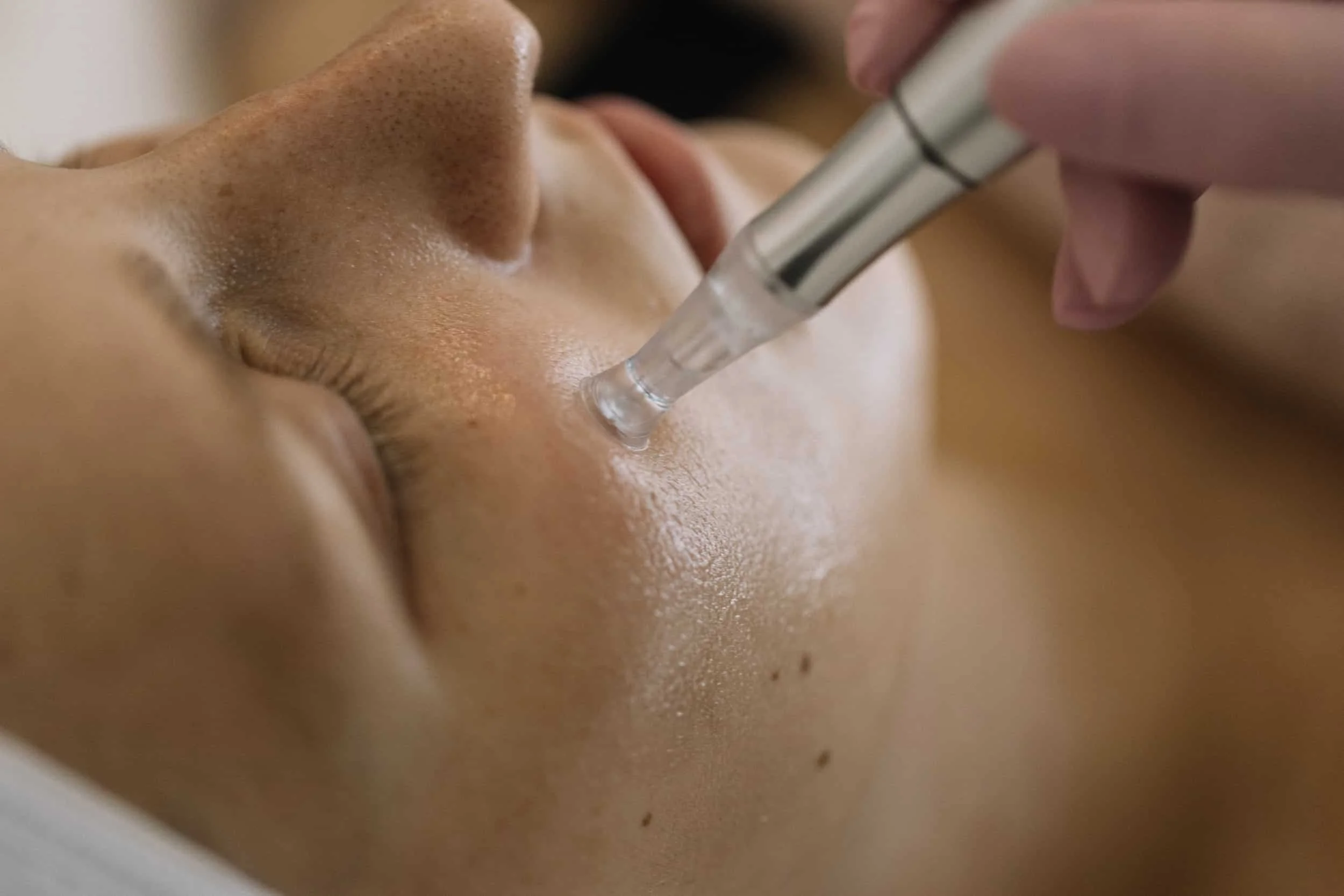 Ihmisen ihoon tehdään geelimäinen injektio kasvoihin Dermatude metahoidossa.