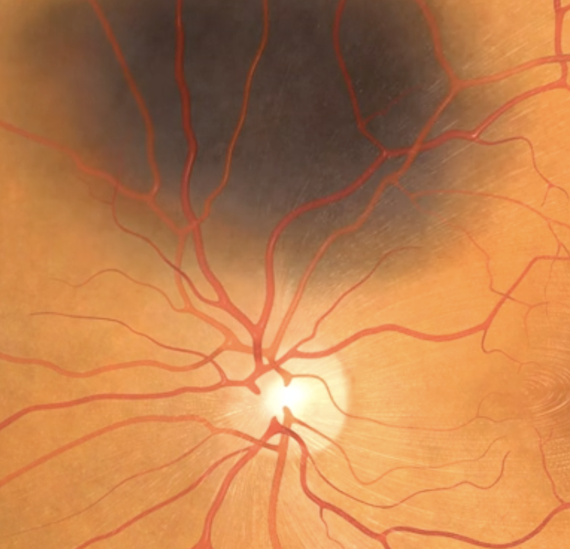Close-up of the human eye's retina showing blood vessels and the optic disc.