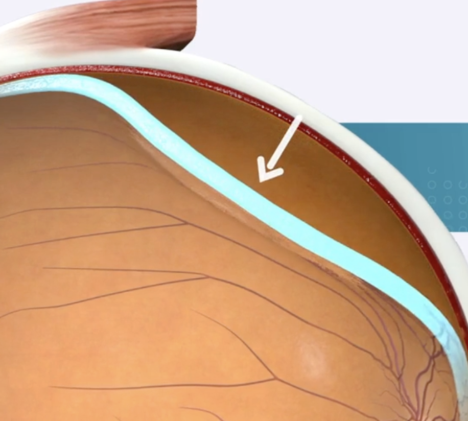 A close-up diagram of a human eye showing the layers, with a focus on the detached retina.