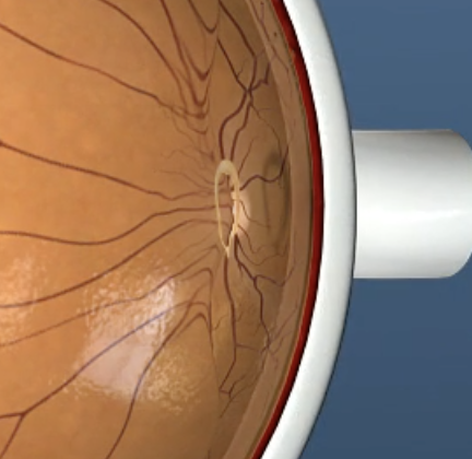Close-up of an eye, showing the retina and optic nerve.