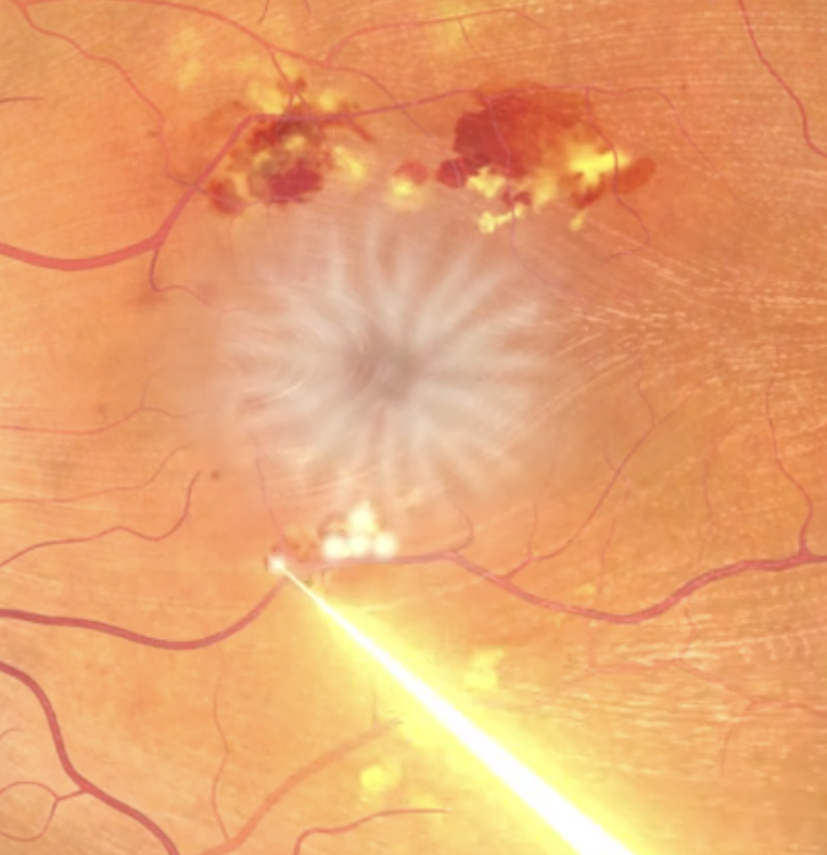 This is an eye with a laser surgery being performed, showing the laser beam targeting the eye's retina.