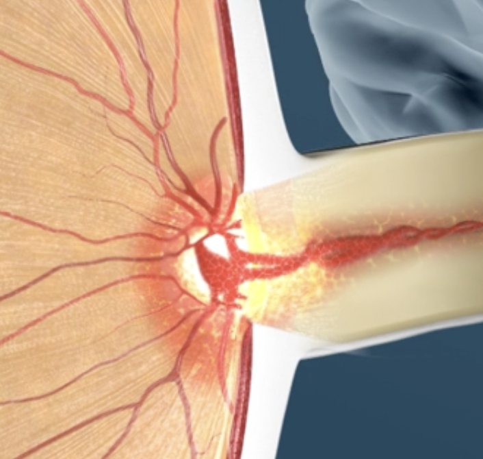 Close-up illustration of the retina depicting optic neuritis.