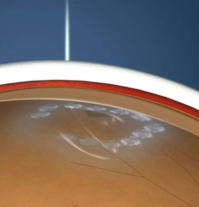Close-up view of a cross-section of the eye with cryotherapy.