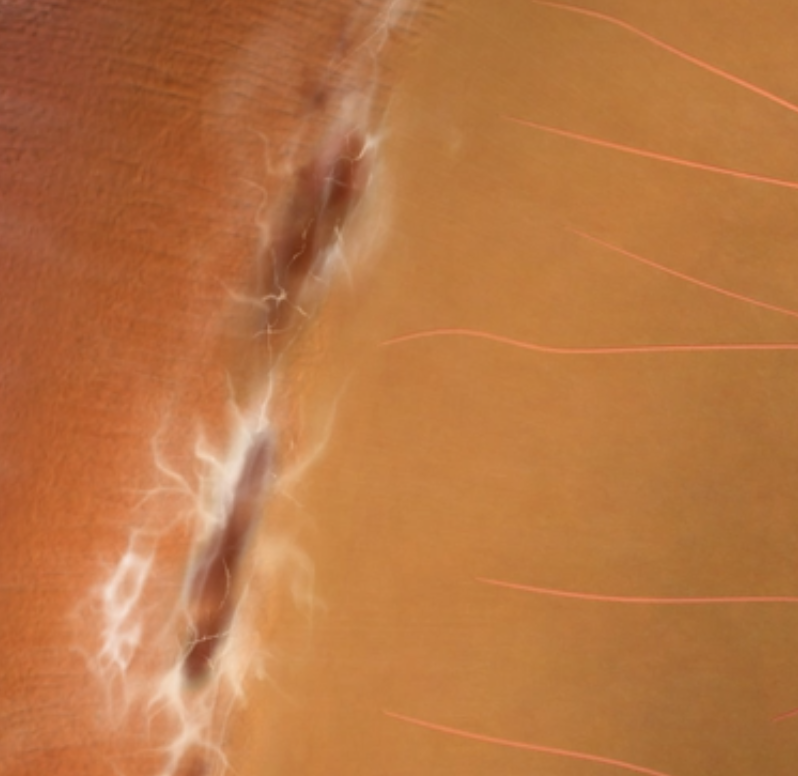 Close-up depiction of what lattice degeneration looks like in the retina.