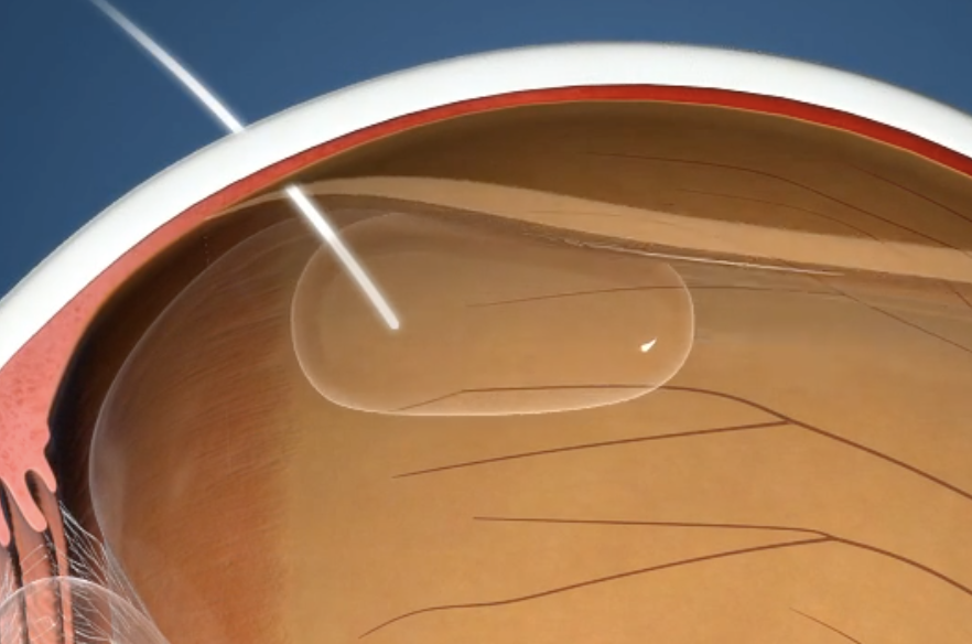 Illustration of a pneumatic retinopexy procedure.