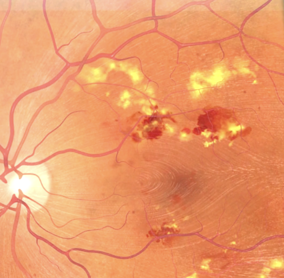 Retinal image showing areas of damage, bleeding, and abnormalities typically associated with diabetic retinopathy.