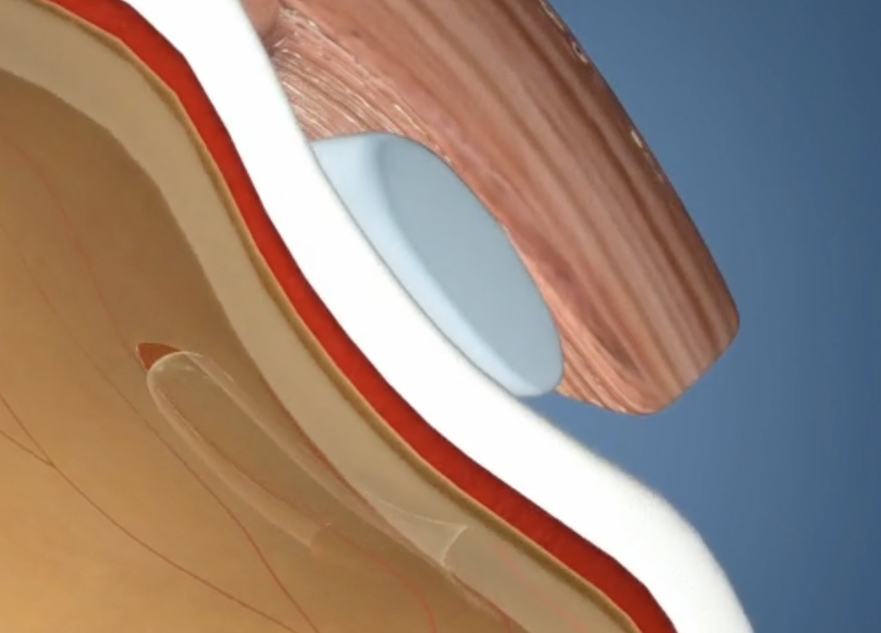 Cross-section of the human eye showing the process of a scleral buckle surgery.