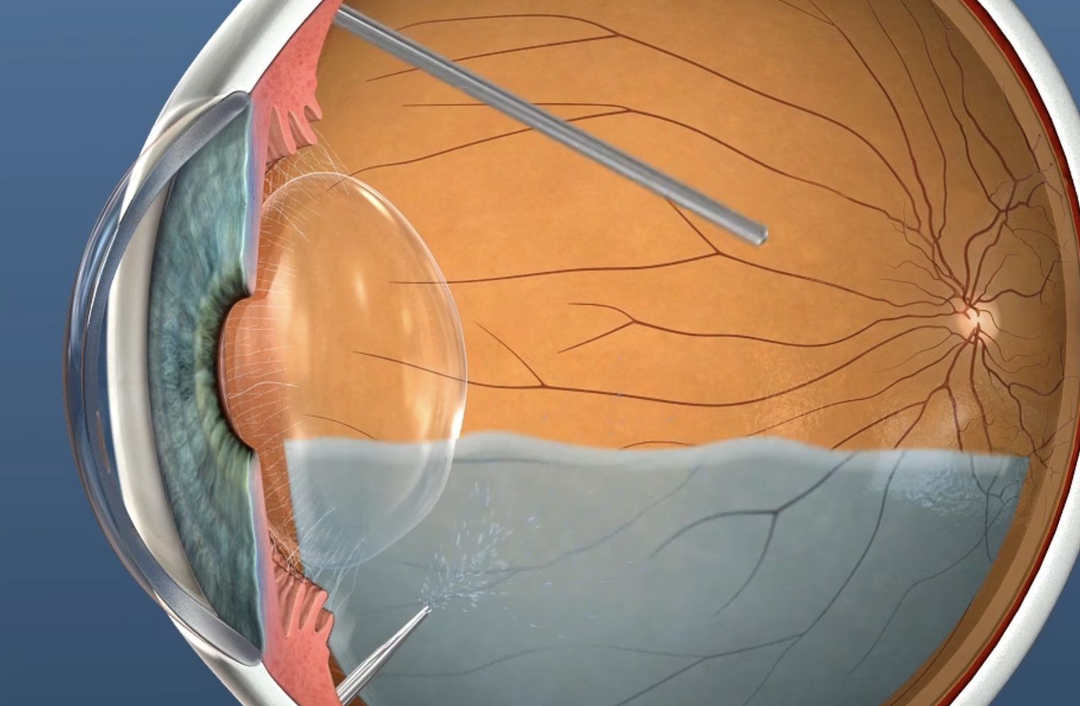 A detailed illustration of a vitrectomy.