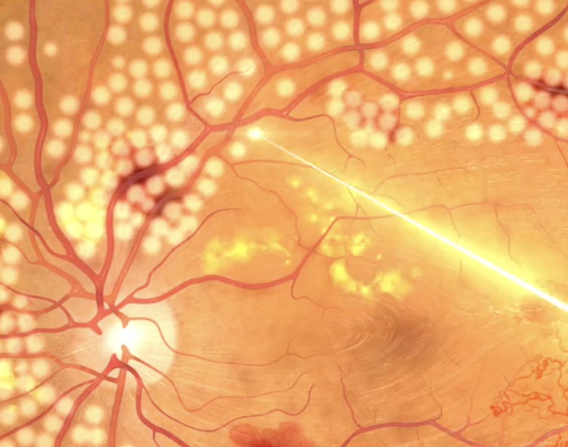 Illustration of a human eye's retina with blood vessels, bright spots, and a laser treatment beam.