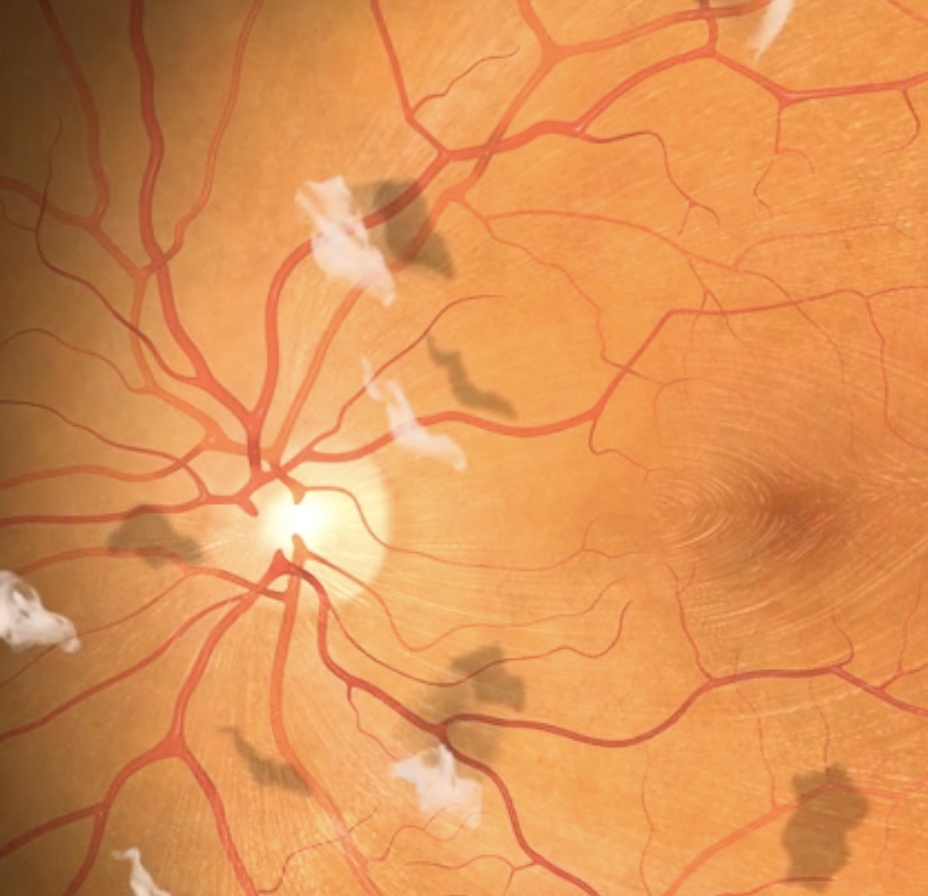 Close-up of an orange retina with red blood vessels and some retinal floaters.