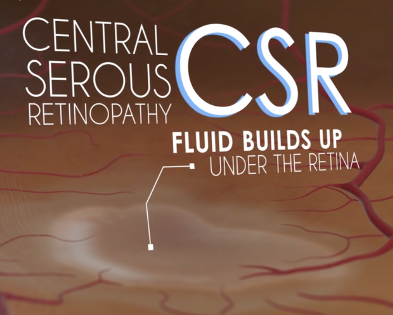 Medical illustration showing blood vessels under the retina with text explaining central serous retinopathy (CSR).