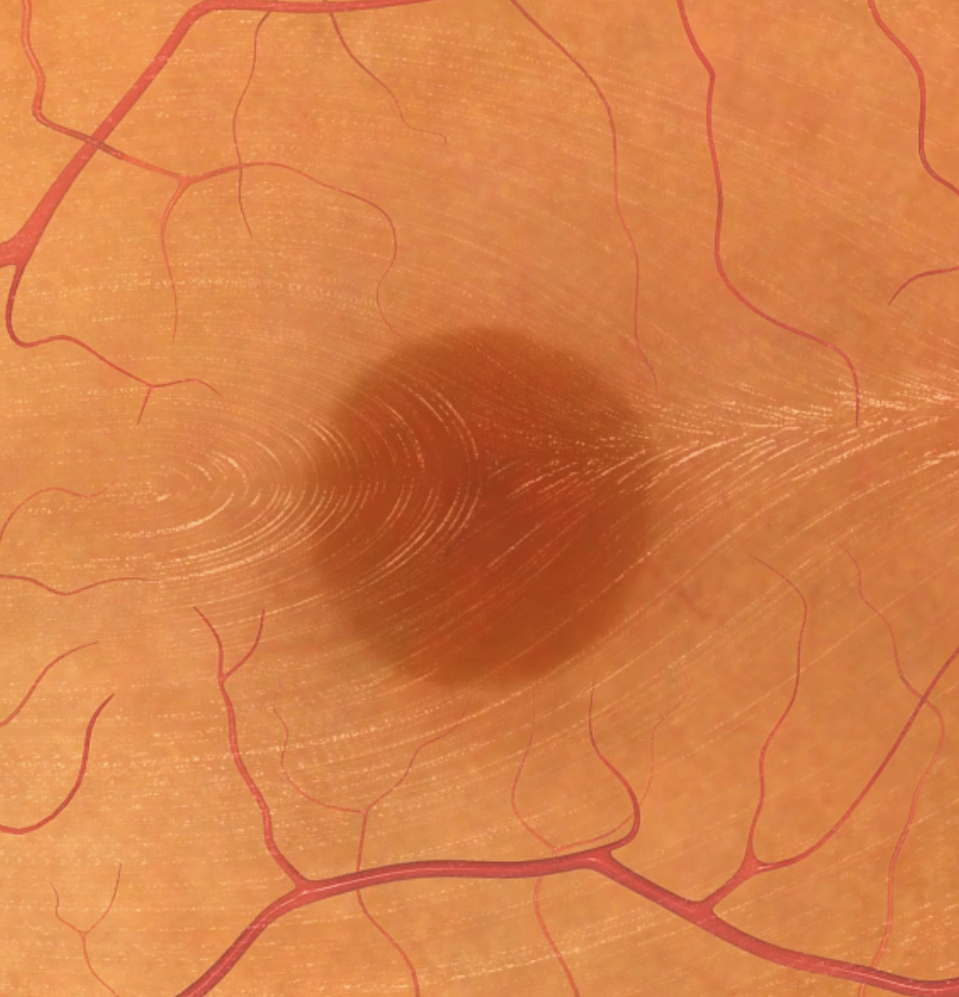 Close-up of a human eye's iris showing blood vessels and a central dark spot.