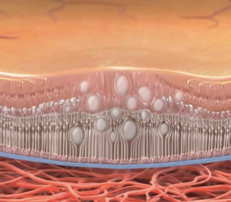 Close-up image of swelling in the macula.