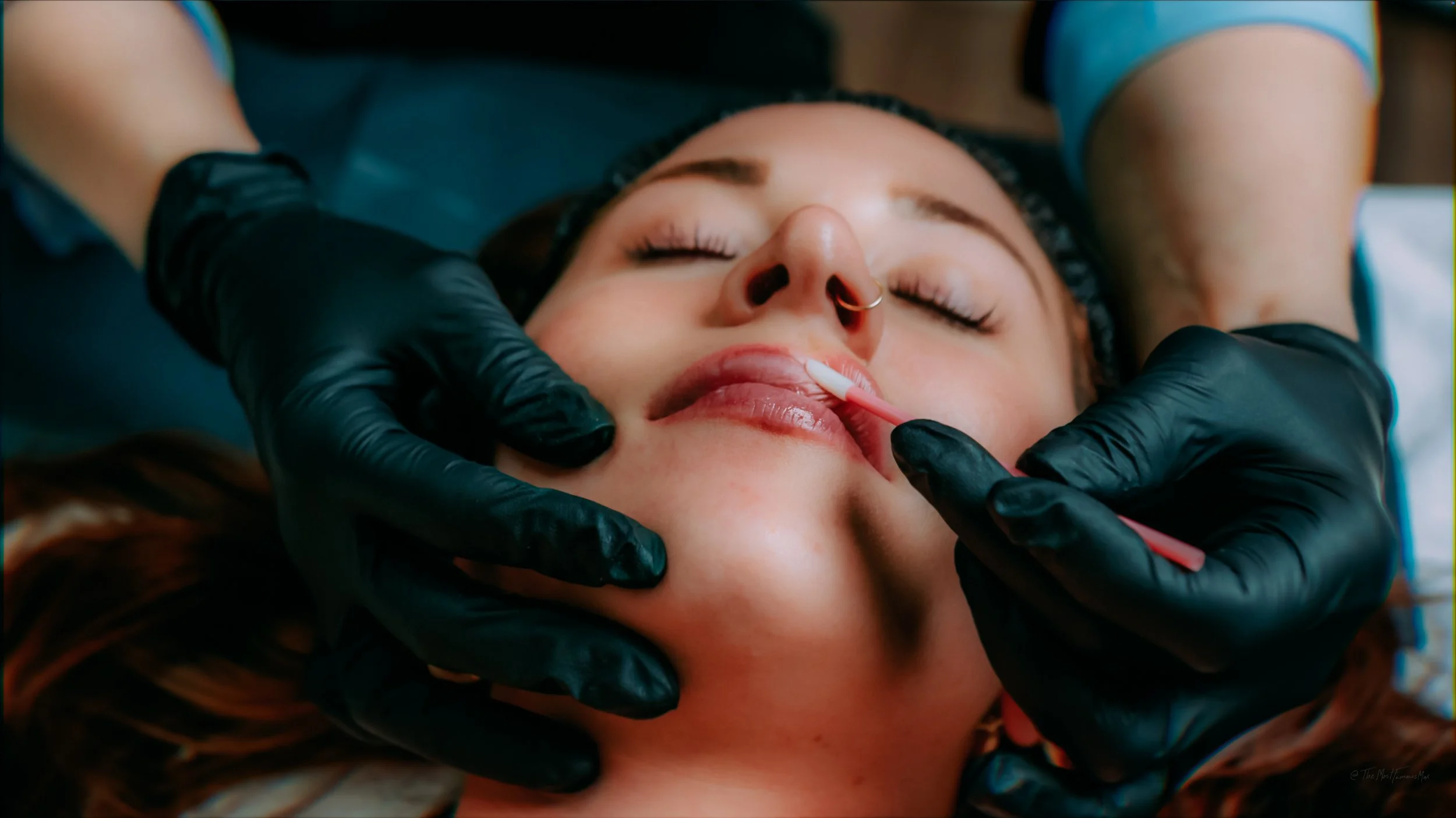 Understanding Dermal Fillers for Natural Volume in Bettendorf, IA