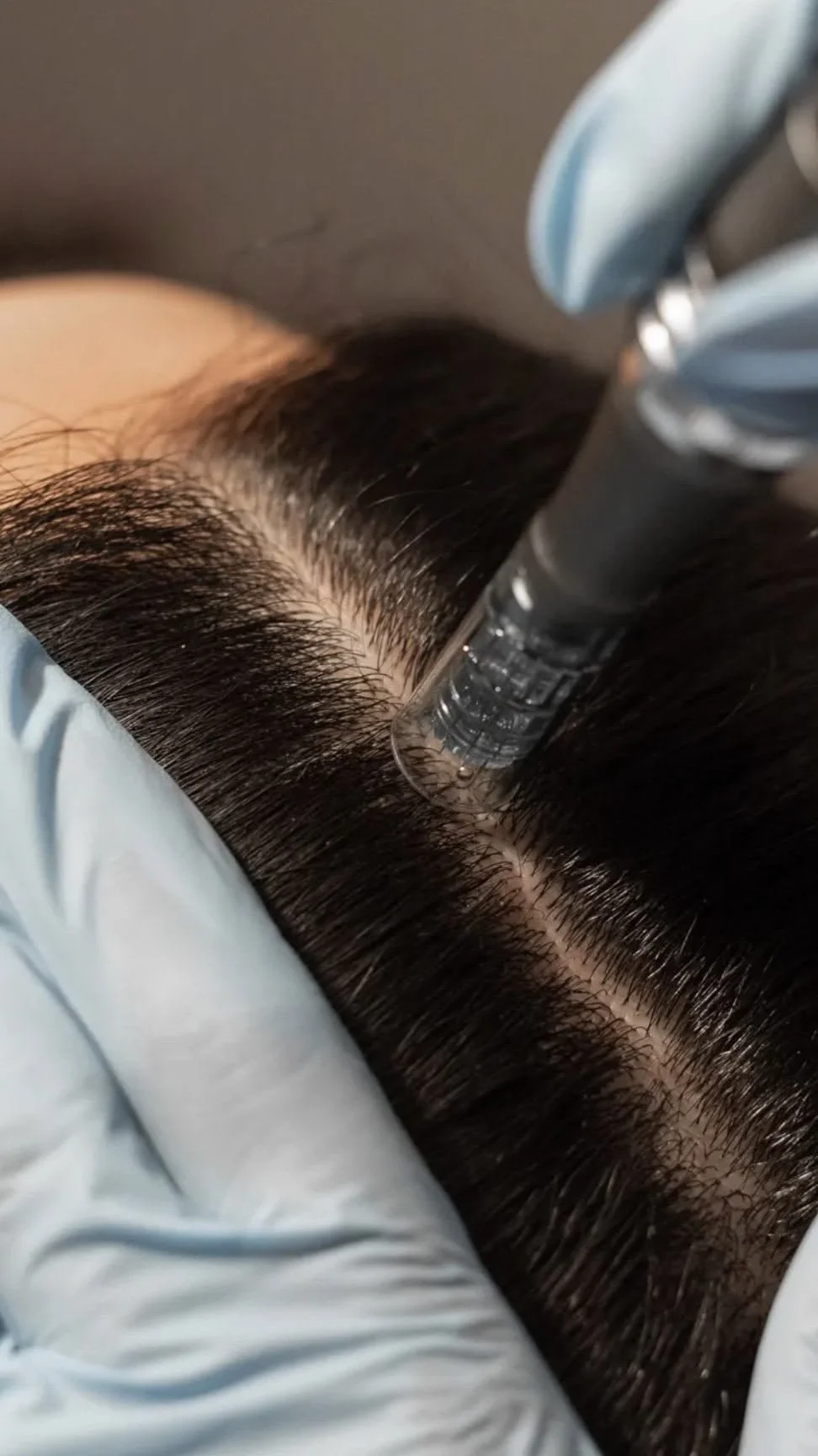 Soin capillaire esthétique – Hair Needling