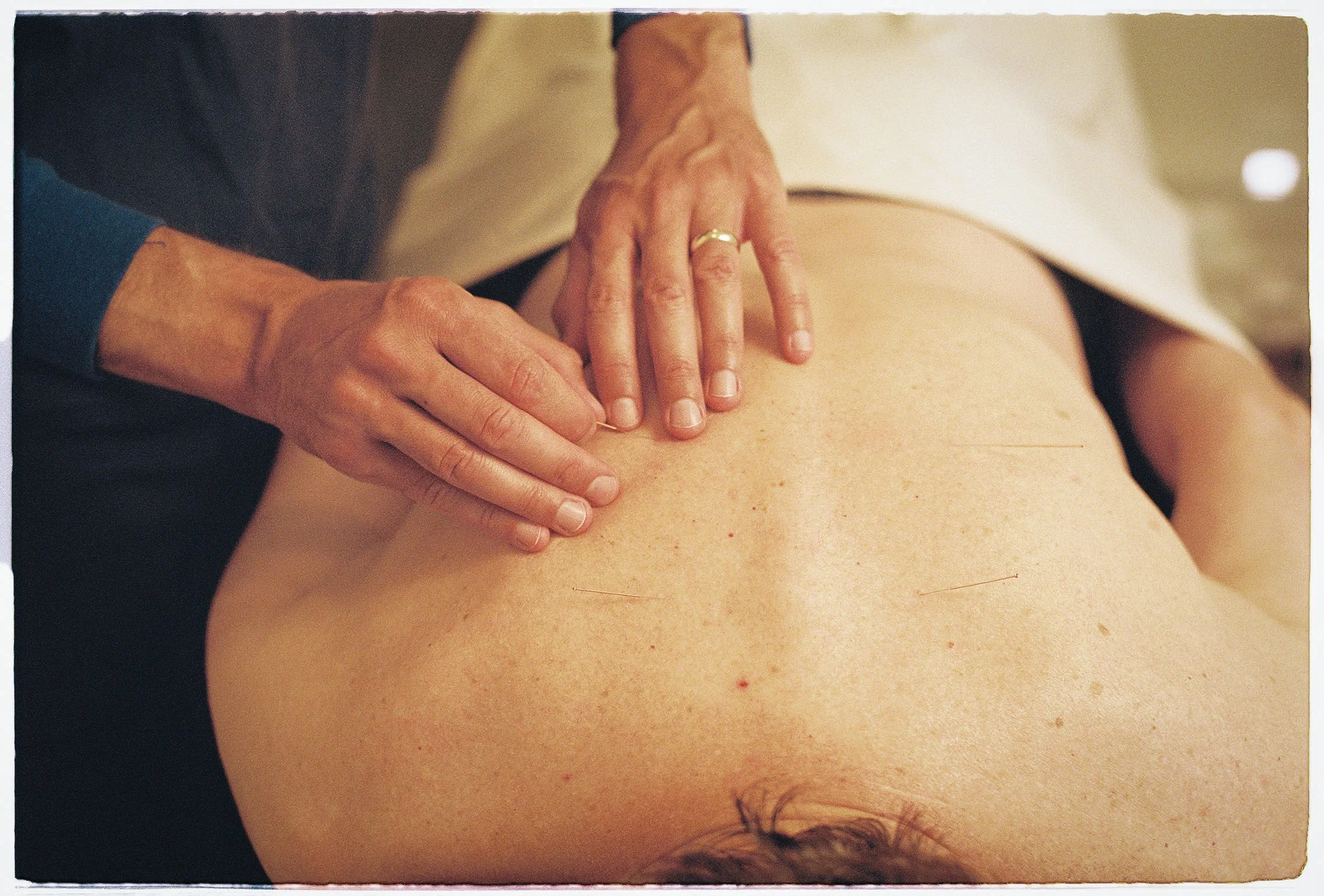 New Patient Intake/ Acupuncture Treatment